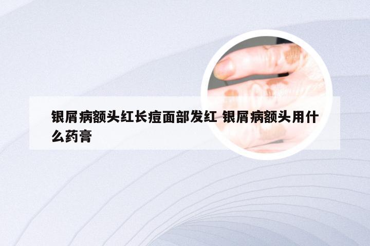 银屑病额头红长痘面部发红 银屑病额头用什么药膏