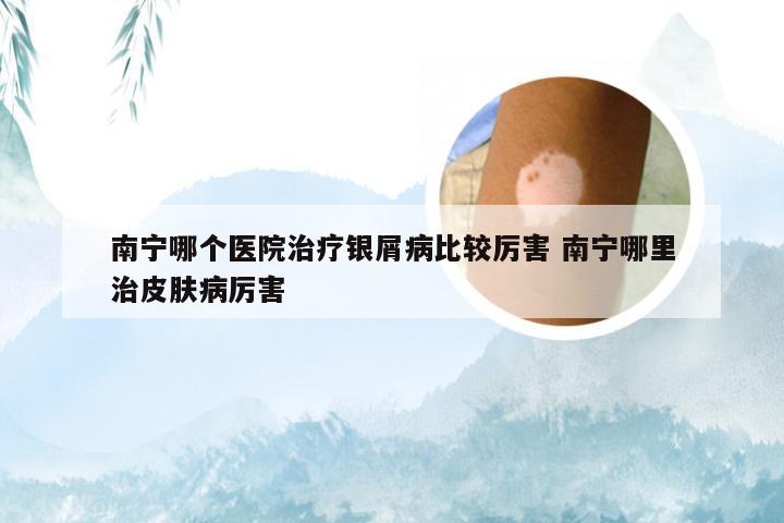 南宁哪个医院治疗银屑病比较厉害 南宁哪里治皮肤病厉害