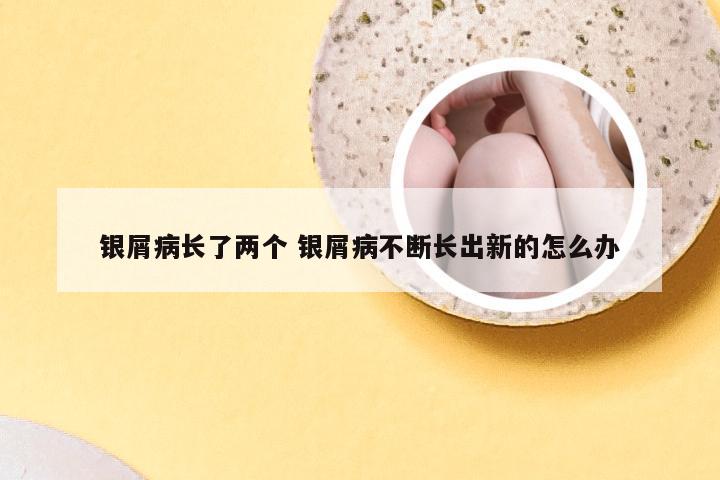 银屑病长了两个 银屑病不断长出新的怎么办