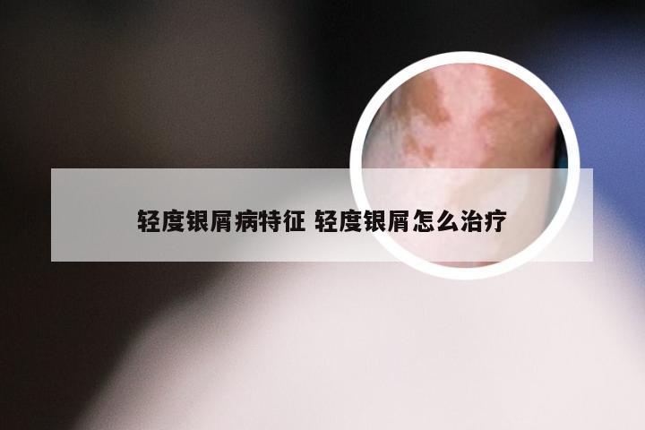 轻度银屑病特征 轻度银屑怎么治疗
