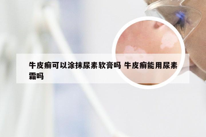 牛皮癣可以涂抹尿素软膏吗 牛皮癣能用尿素霜吗