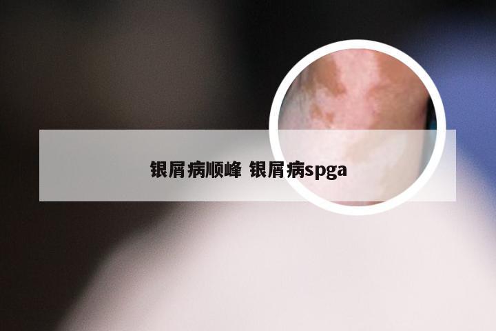 银屑病顺峰 银屑病spga