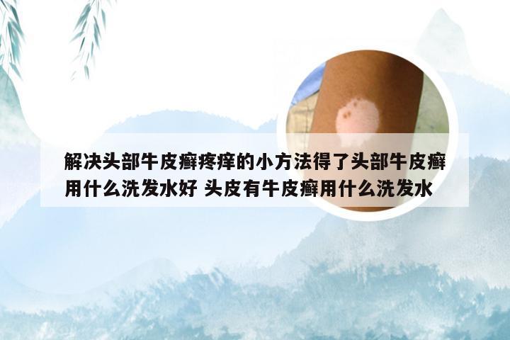 解决头部牛皮癣疼痒的小方法得了头部牛皮癣用什么洗发水好 头皮有牛皮癣用什么洗发水