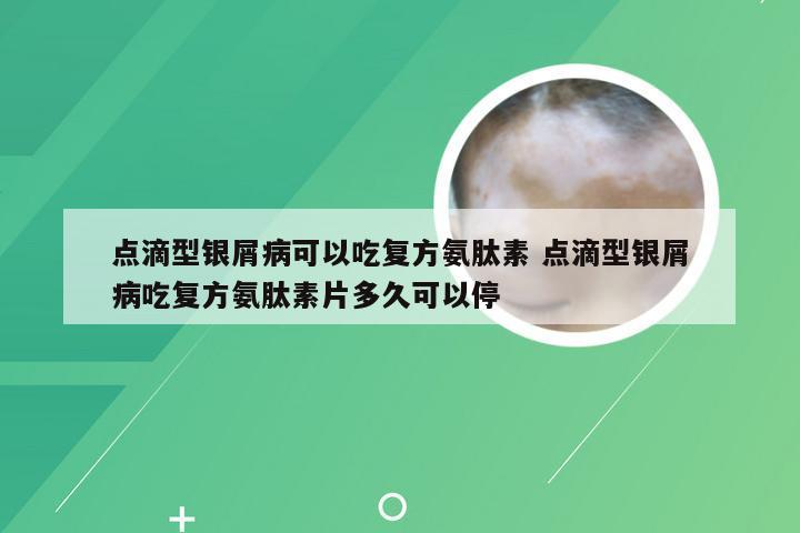 点滴型银屑病可以吃复方氨肽素 点滴型银屑病吃复方氨肽素片多久可以停