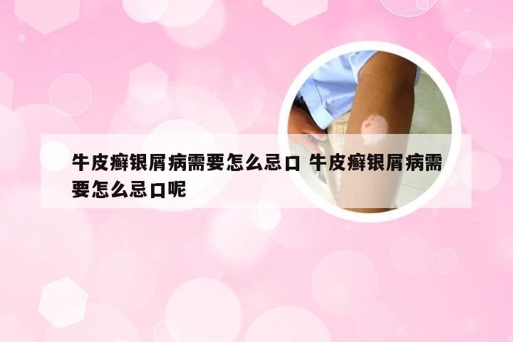 牛皮癣银屑病需要怎么忌口 牛皮癣银屑病需要怎么忌口呢