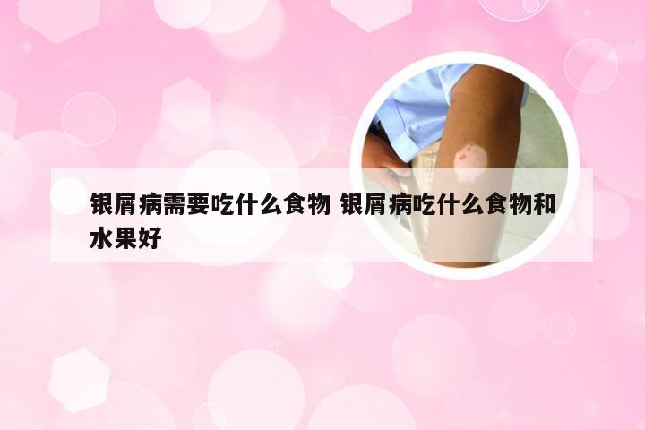 银屑病需要吃什么食物 银屑病吃什么食物和水果好