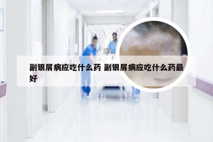 副银屑病应吃什么药 副银屑病应吃什么药最好