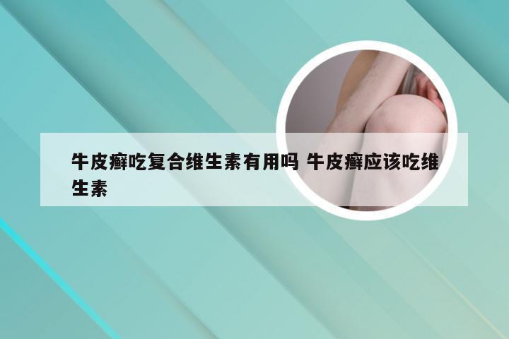 牛皮癣吃复合维生素有用吗 牛皮癣应该吃维生素