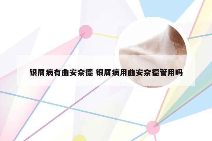 银屑病有曲安奈德 银屑病用曲安奈德管用吗
