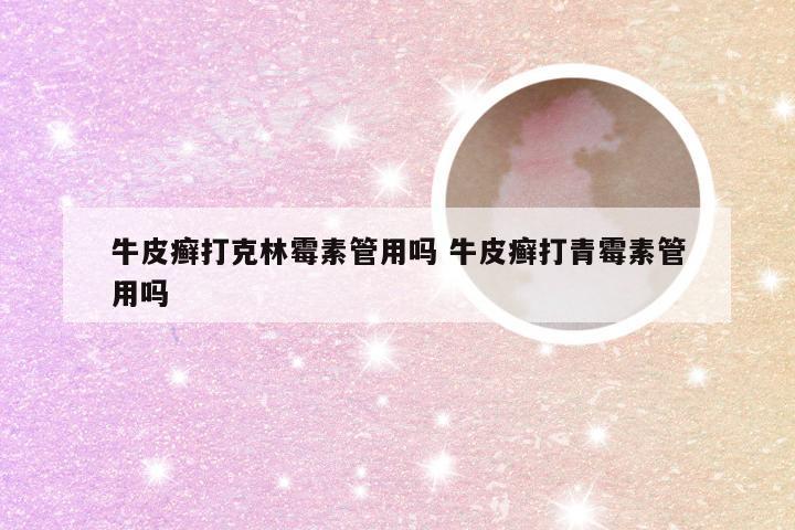 牛皮癣打克林霉素管用吗 牛皮癣打青霉素管用吗