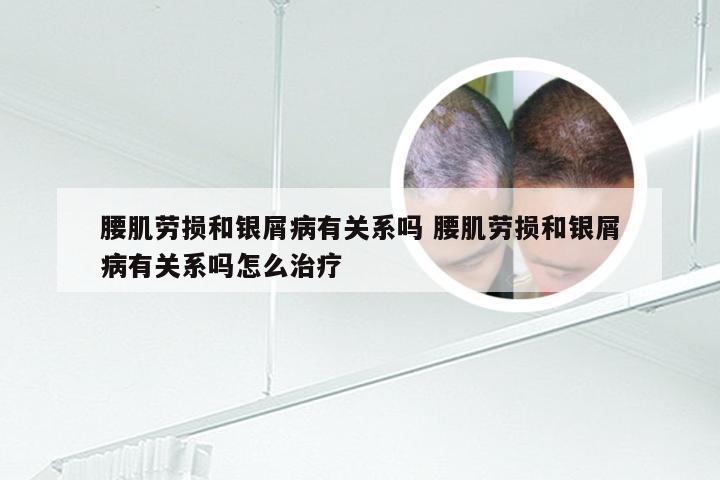 腰肌劳损和银屑病有关系吗 腰肌劳损和银屑病有关系吗怎么治疗