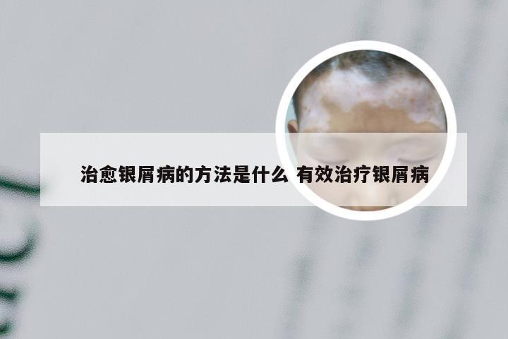 治愈银屑病的方法是什么 有效治疗银屑病