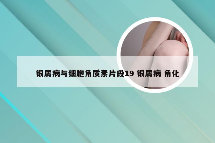 银屑病与细胞角质素片段19 银屑病 角化