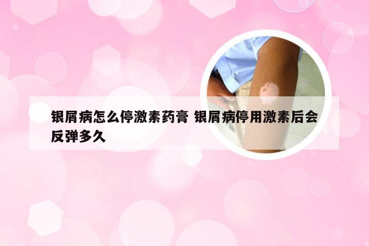 银屑病怎么停激素药膏 银屑病停用激素后会反弹多久