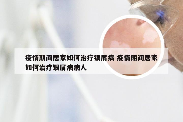 疫情期间居家如何治疗银屑病 疫情期间居家如何治疗银屑病病人
