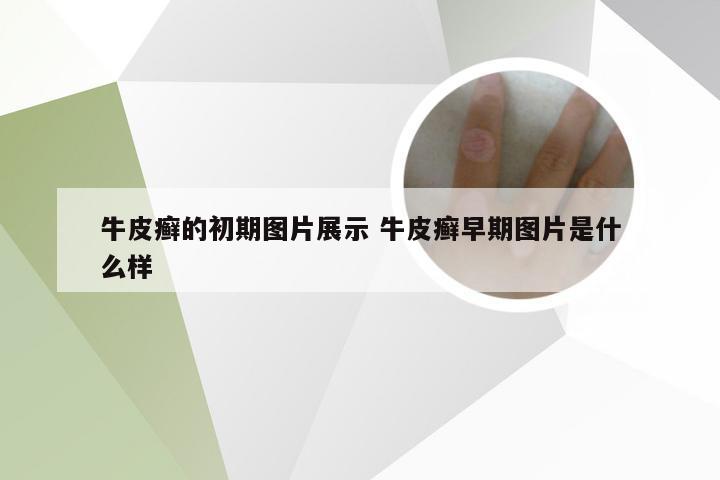 牛皮癣的初期图片展示 牛皮癣早期图片是什么样