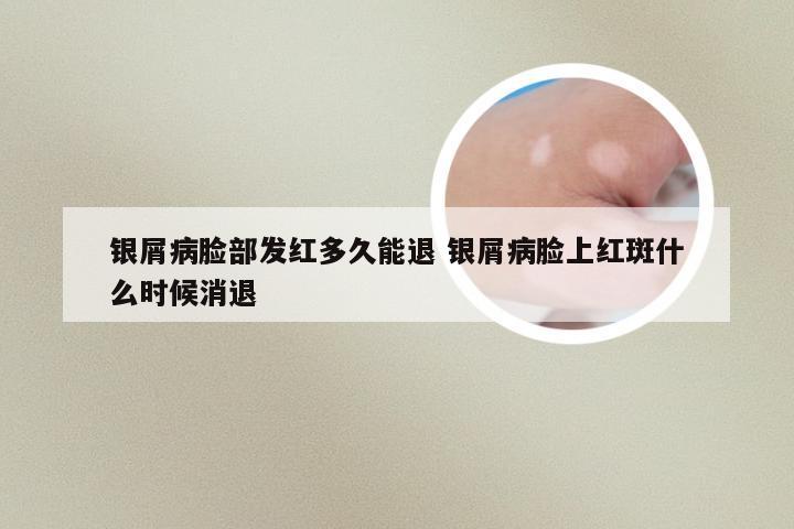 银屑病脸部发红多久能退 银屑病脸上红斑什么时候消退