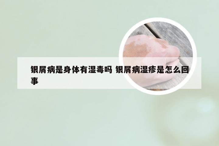 银屑病是身体有湿毒吗 银屑病湿疹是怎么回事
