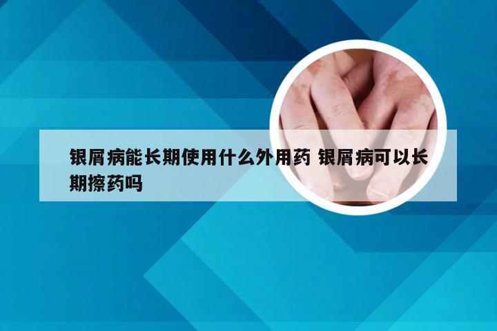 银屑病能长期使用什么外用药 银屑病可以长期擦药吗