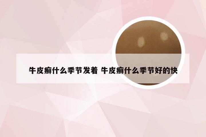 牛皮癣什么季节发着 牛皮癣什么季节好的快