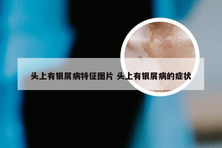 头上有银屑病特征图片 头上有银屑病的症状