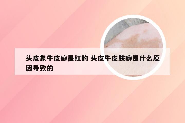 头皮象牛皮癣是红的 头皮牛皮肤癣是什么原因导致的