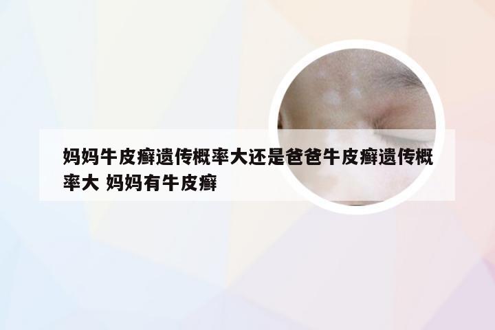 妈妈牛皮癣遗传概率大还是爸爸牛皮癣遗传概率大 妈妈有牛皮癣
