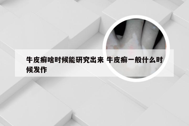 牛皮癣啥时候能研究出来 牛皮癣一般什么时候发作