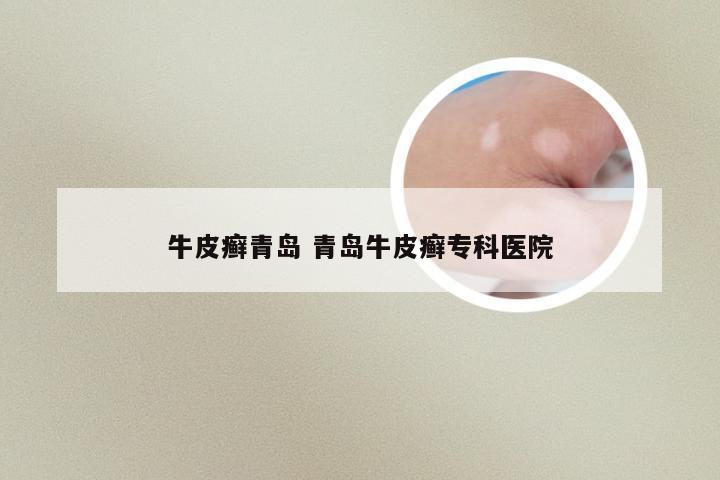牛皮癣青岛 青岛牛皮癣专科医院