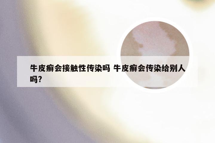牛皮癣会接触性传染吗 牛皮癣会传染给别人吗?