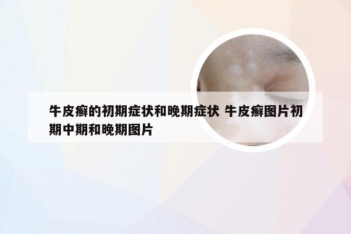 牛皮癣的初期症状和晚期症状 牛皮癣图片初期中期和晚期图片