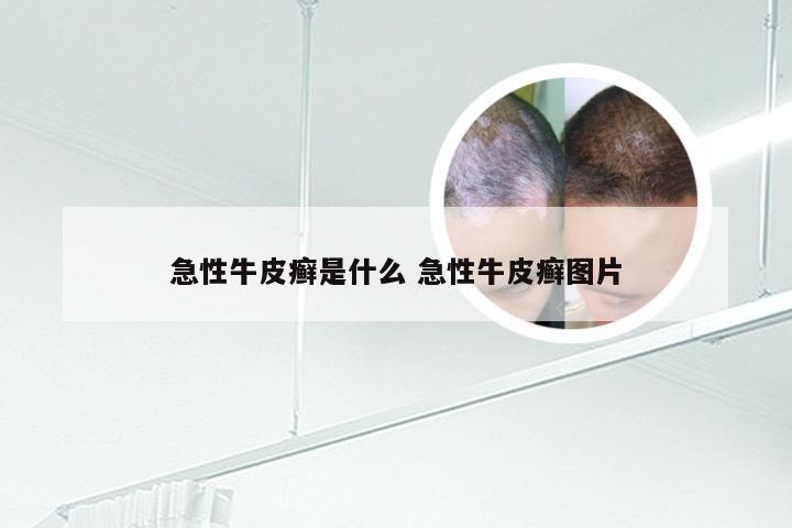 急性牛皮癣是什么 急性牛皮癣图片