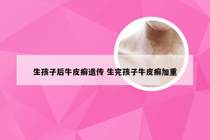 生孩子后牛皮癣遗传 生完孩子牛皮癣加重