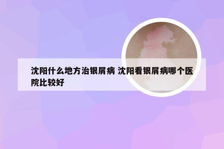 沈阳什么地方治银屑病 沈阳看银屑病哪个医院比较好