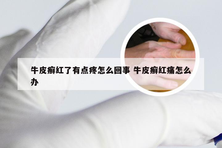 牛皮癣红了有点疼怎么回事 牛皮癣红痛怎么办