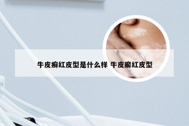 牛皮癣红皮型是什么样 牛皮廨红皮型