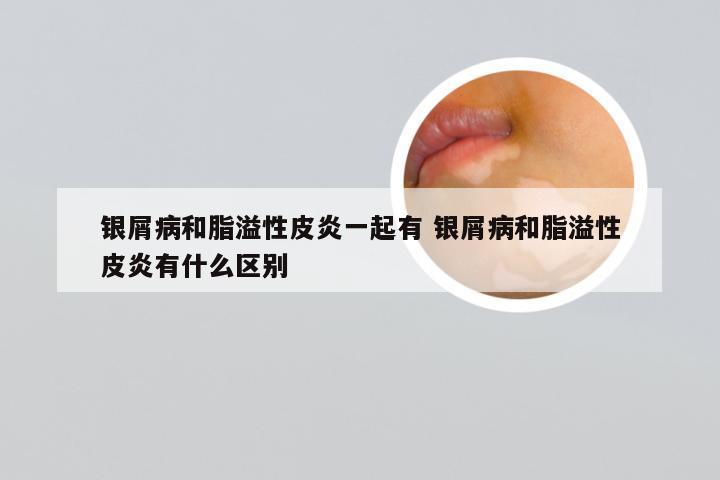 银屑病和脂溢性皮炎一起有 银屑病和脂溢性皮炎有什么区别