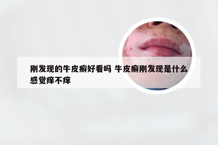 刚发现的牛皮癣好看吗 牛皮癣刚发现是什么感觉痒不痒