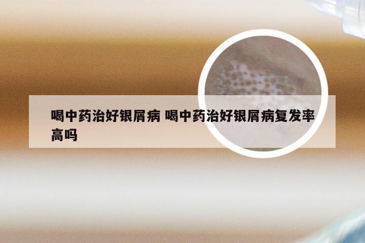 喝中药治好银屑病 喝中药治好银屑病复发率高吗