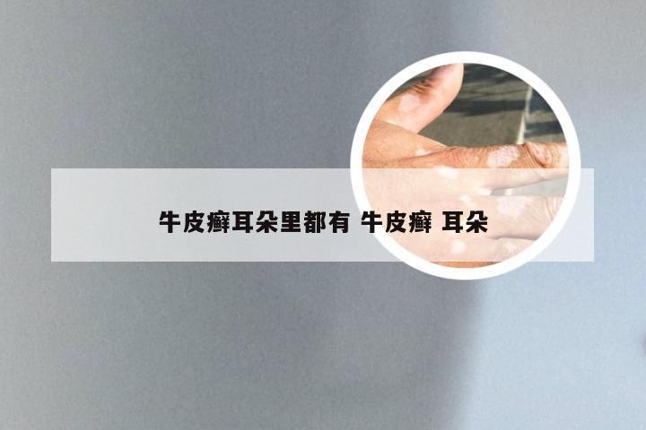 牛皮癣耳朵里都有 牛皮癣 耳朵