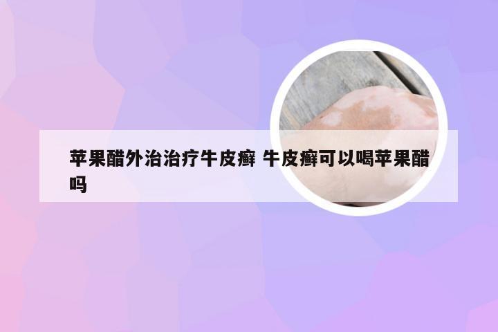 苹果醋外治治疗牛皮癣 牛皮癣可以喝苹果醋吗