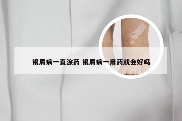银屑病一直涂药 银屑病一用药就会好吗