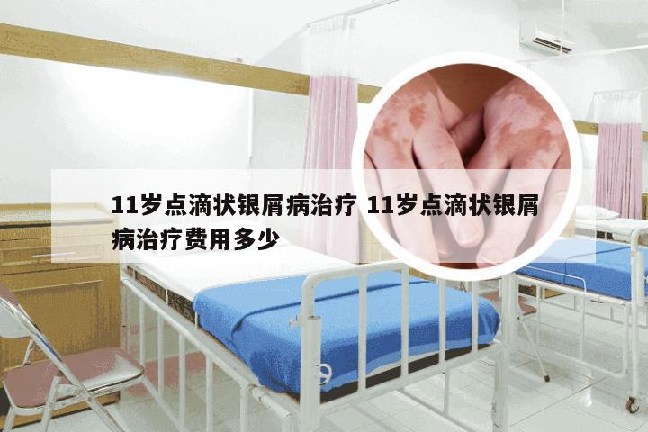 11岁点滴状银屑病治疗 11岁点滴状银屑病治疗费用多少