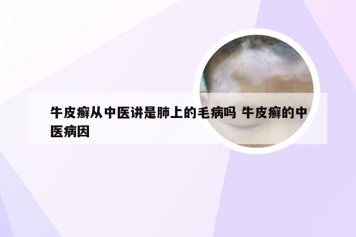 牛皮癣从中医讲是肺上的毛病吗 牛皮癣的中医病因