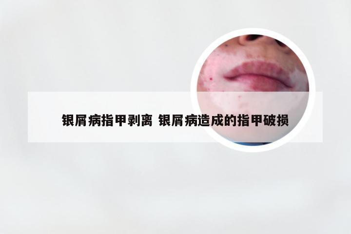 银屑病指甲剥离 银屑病造成的指甲破损