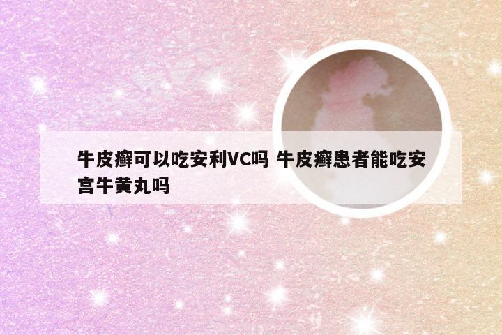 牛皮癣可以吃安利VC吗 牛皮癣患者能吃安宫牛黄丸吗