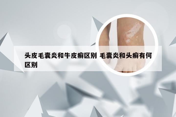 头皮毛囊炎和牛皮癣区别 毛囊炎和头癣有何区别