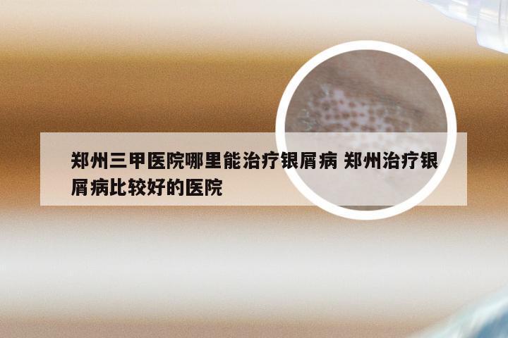 郑州三甲医院哪里能治疗银屑病 郑州治疗银屑病比较好的医院