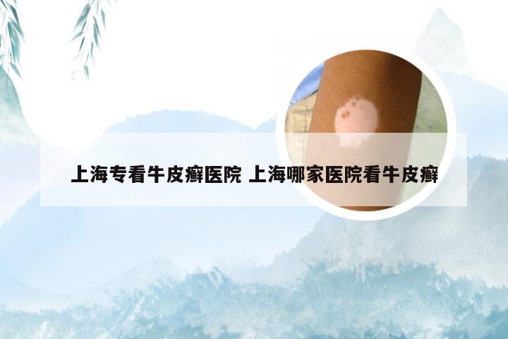 上海专看牛皮癣医院 上海哪家医院看牛皮癣