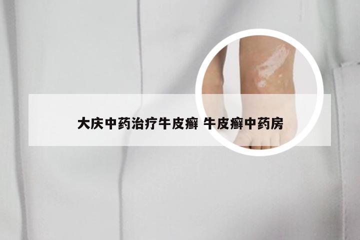大庆中药治疗牛皮癣 牛皮癣中药房